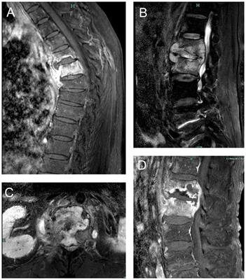 The value of histopathology combined with CapitalBio Mycobacterium real-time polymerase chain reaction test for diagnosing spinal tuberculosis